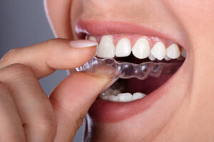 What Are the Benefits of an Invisalign Treatment?